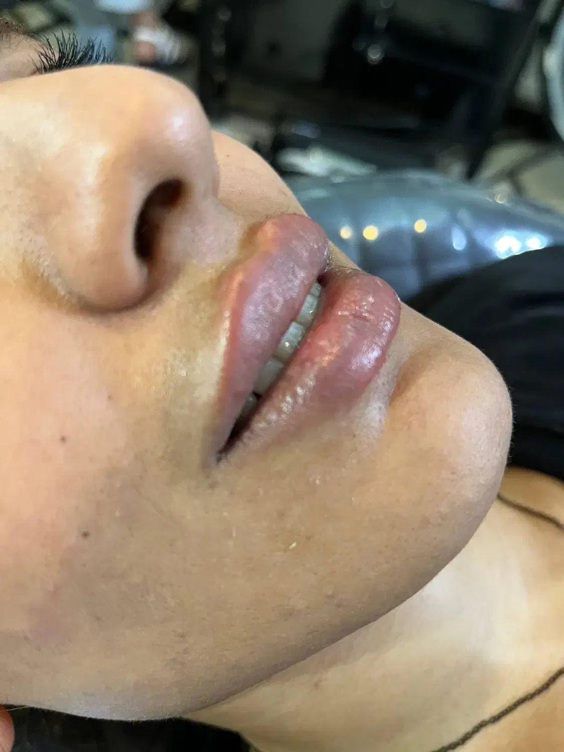 ژل و بوتاکس|خدمات آرایشگری و زیبایی|مشهد, ایثار|دیوار