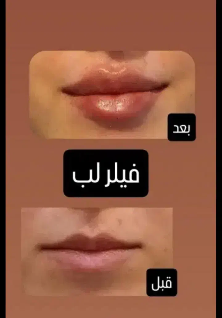 ژل لب گونه چونه زاویه مادلینگ راویه سازی|خدمات آرایشگری و زیبایی|قم, تولید دارو و یخچال|دیوار