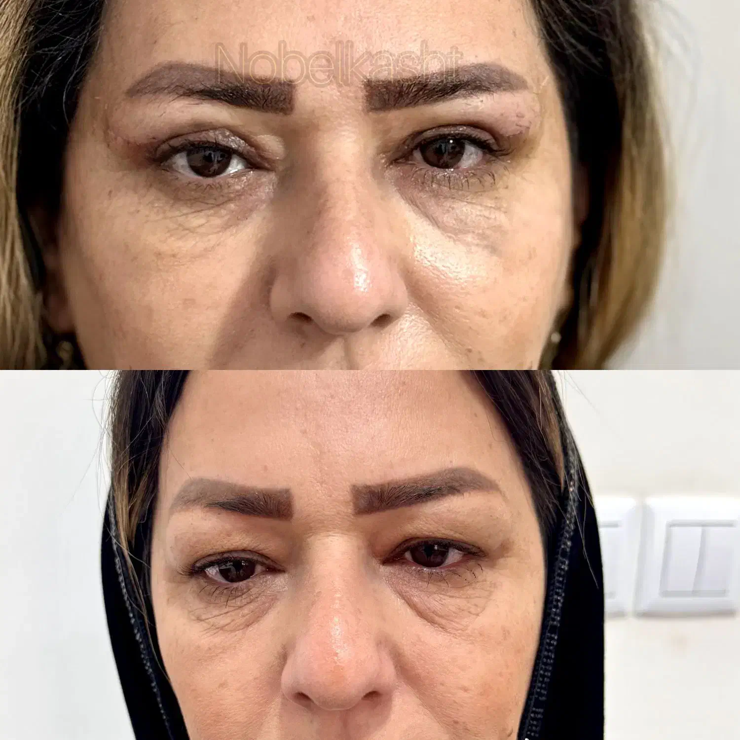 بلفاروپلاستی|خدمات آرایشگری و زیبایی|ارومیه, |دیوار