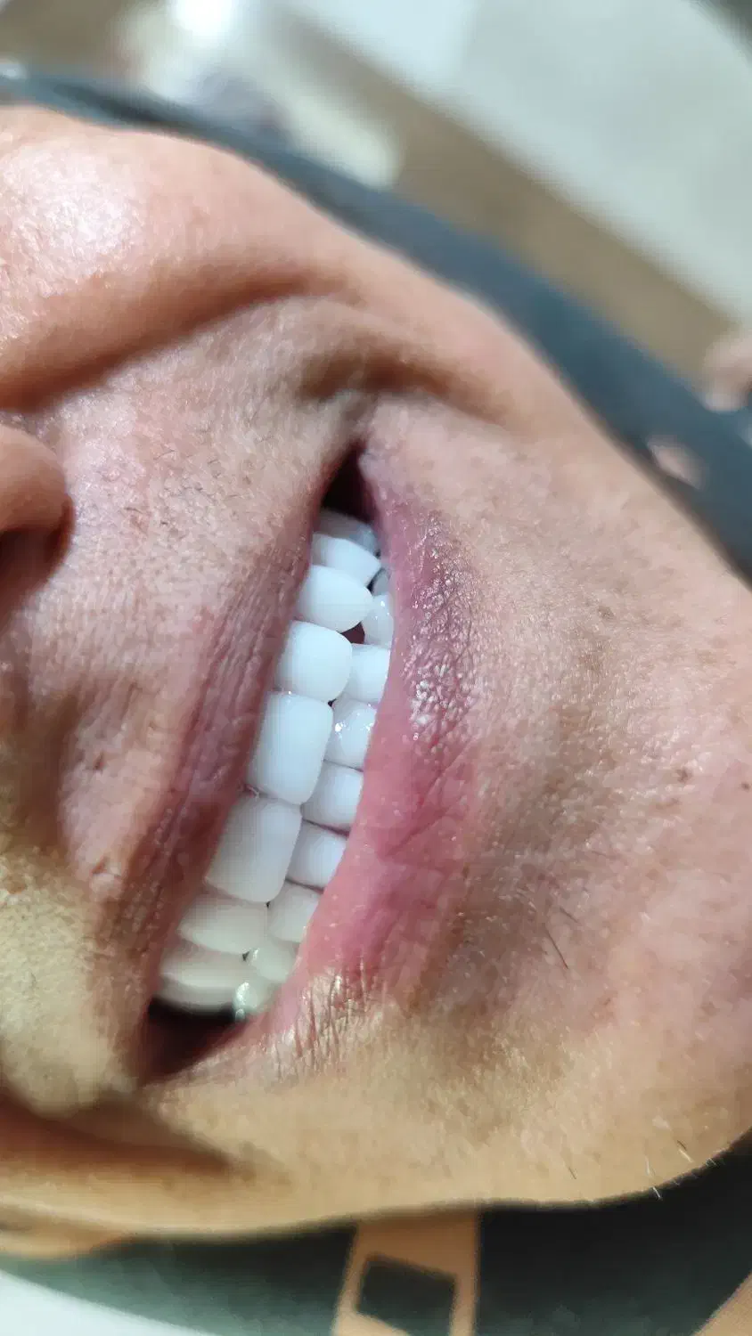 دندان مصنوعی طرح کامپوزیت و لمینت هر فک ۵ تومان|خدمات آرایشگری و زیبایی|کرج, کمالشهر|دیوار