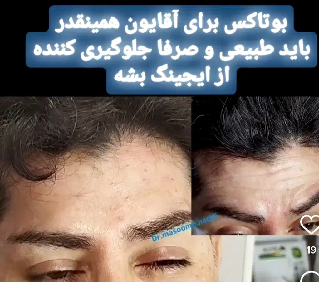 بوتاکس طبیعی درهرسنی|خدمات آرایشگری و زیبایی|رشت, بلوار گیلان|دیوار