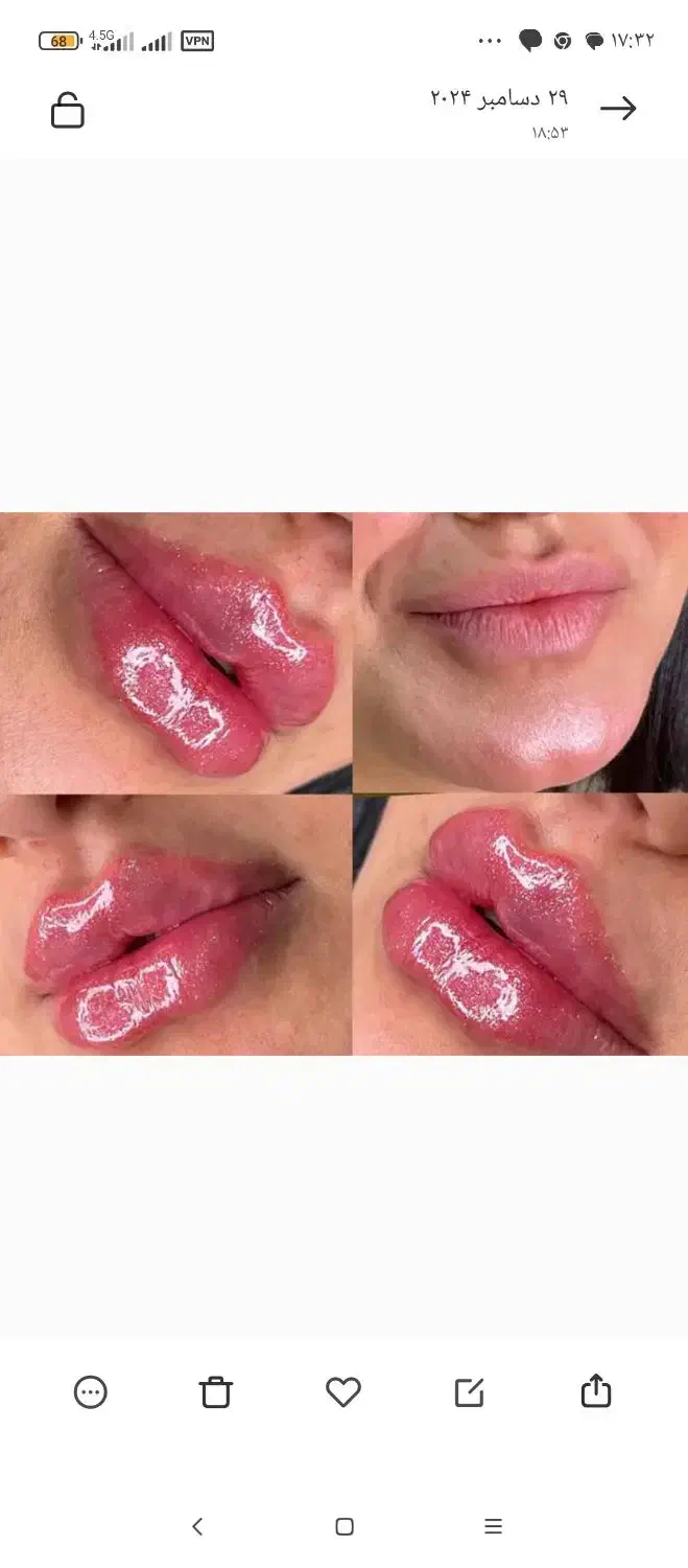 تزریق چربی .فیلر.نخ.ژل|خدمات آرایشگری و زیبایی|جهرم, |دیوار