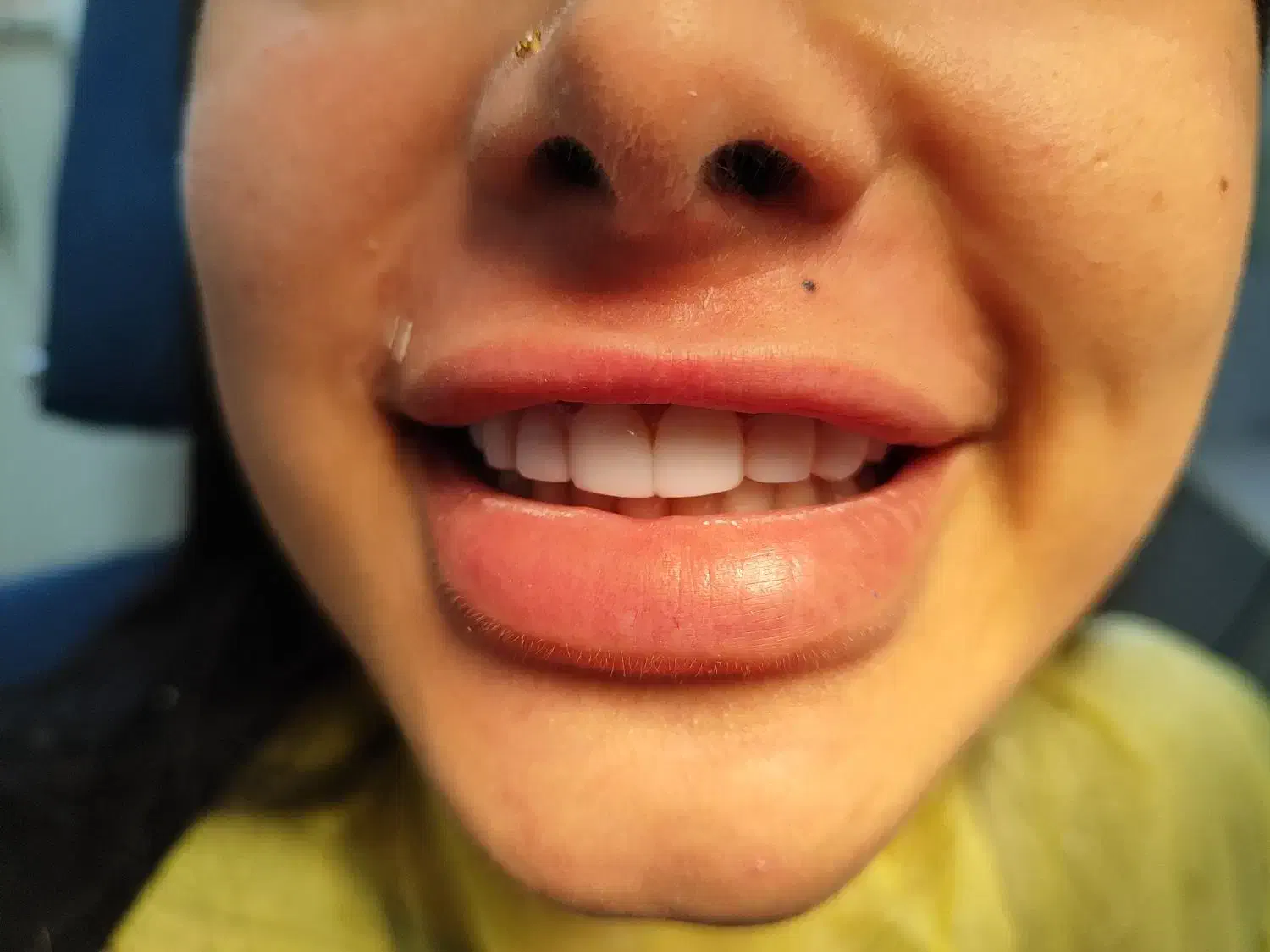 جشنواره کامپوزیت 8000 م ،عصب کشی از۲۵۰۰ توسط پزشک|خدمات آرایشگری و زیبایی|رشت, دروازه لاکان|دیوار