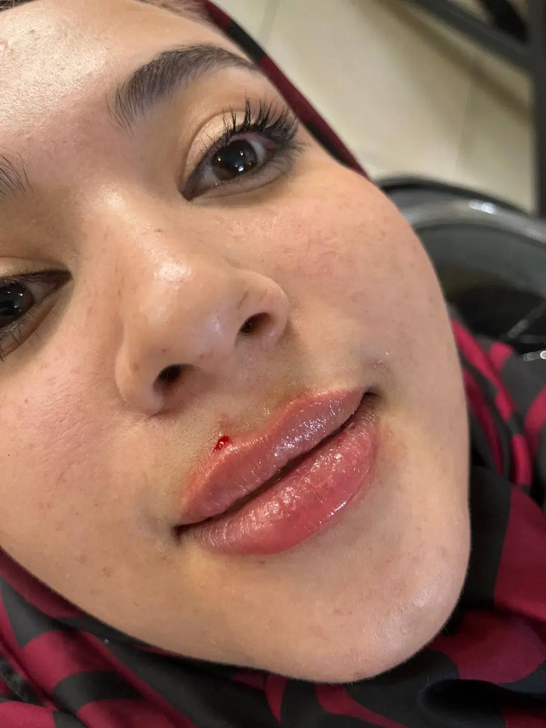 ژل و بوتاکس|خدمات آرایشگری و زیبایی|مشهد, ایثار|دیوار