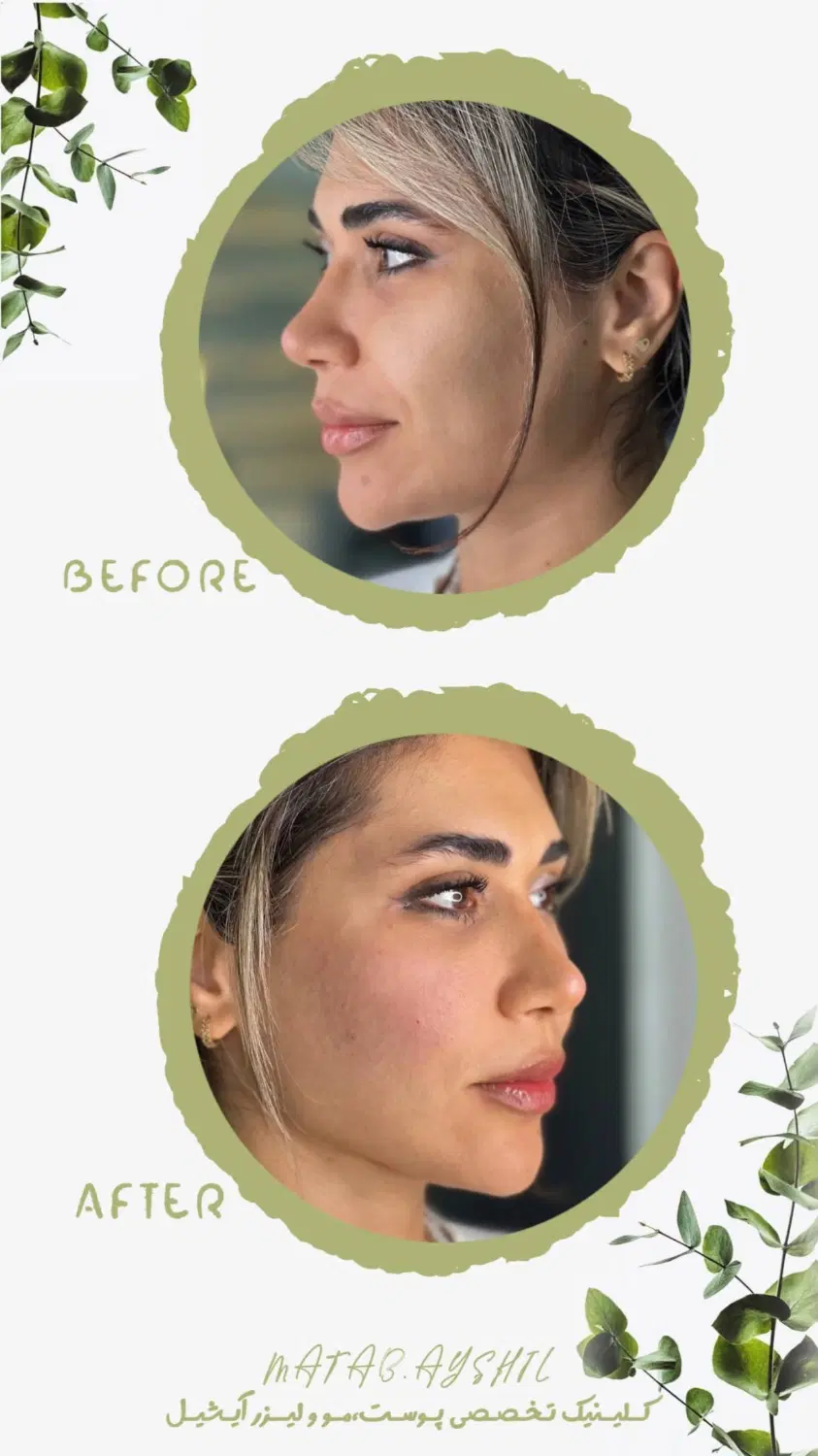 کلینیک بوتاکس وفیلر و هایفو و فیلر بادی و ریموتتو|خدمات زیبایی و سلامت|کرج, عظیمیه|دیوار