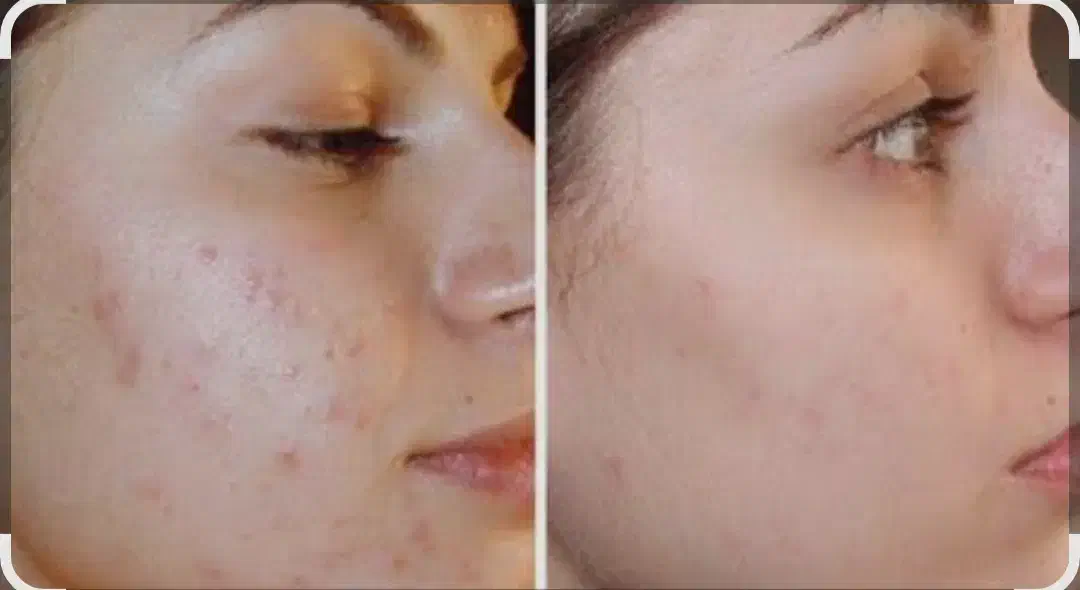 انجام خدمات مزوتراپی و مزوندیلینگ|خدمات آرایشگری و زیبایی|بوشهر, |دیوار