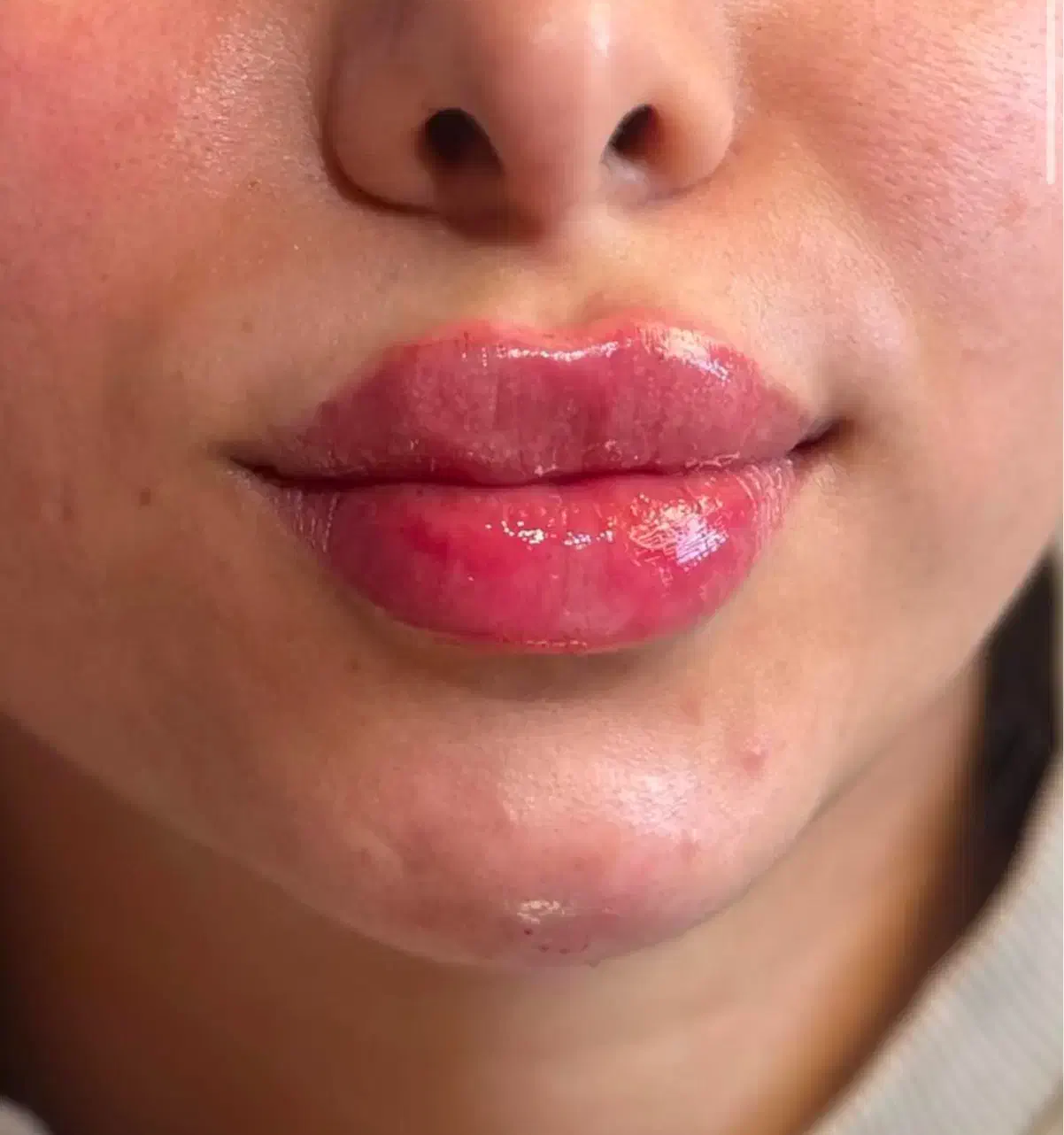 تخفیف خاص لیپوساکشن فیلر بوتاکس|خدمات آرایشگری و زیبایی|کرمانشاه, |دیوار