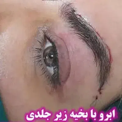 ژل بوتاکس چربی بلفارو|خدمات آرایشگری و زیبایی|اهواز, شهرک دانشگاه|دیوار