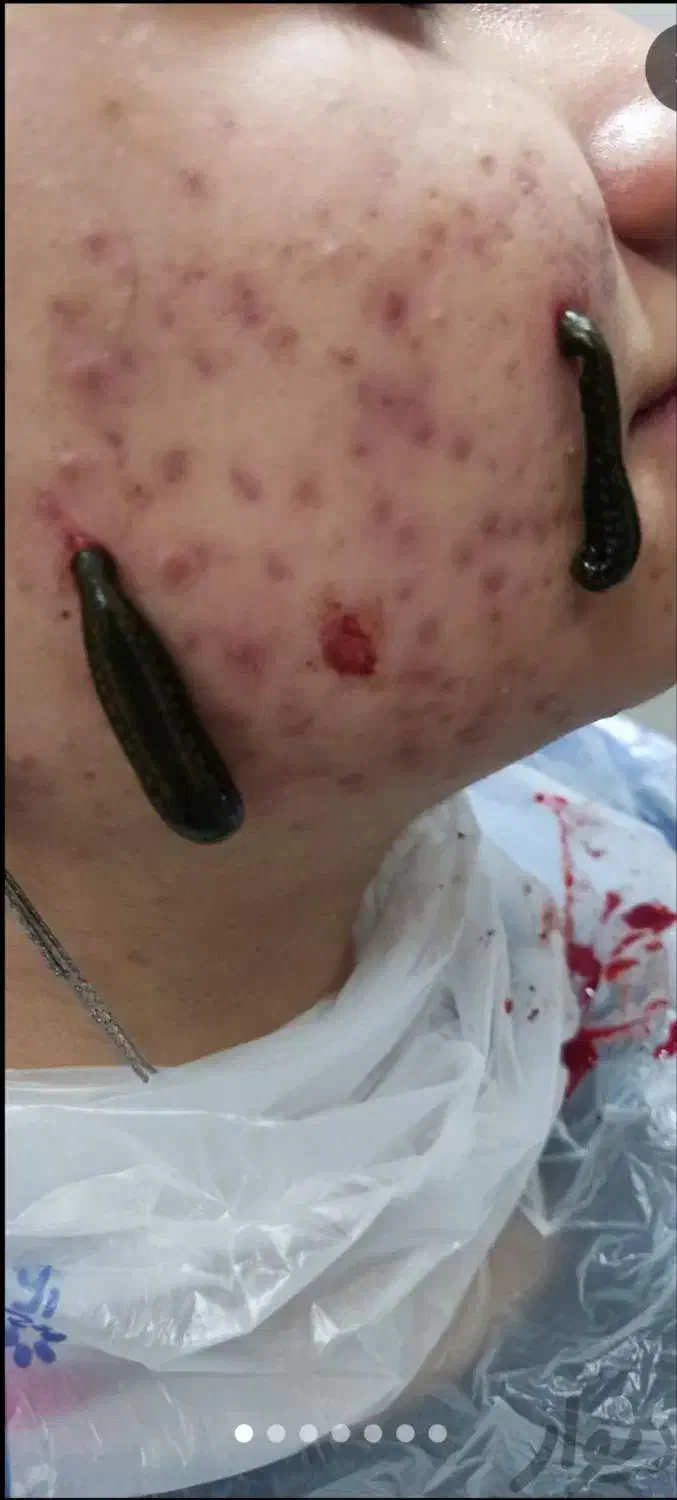 انواع حجامت، زالودرمانی، بادکش، کایروپراکتیک|خدمات آرایشگری و زیبایی|سبزوار, سیادتی|دیوار