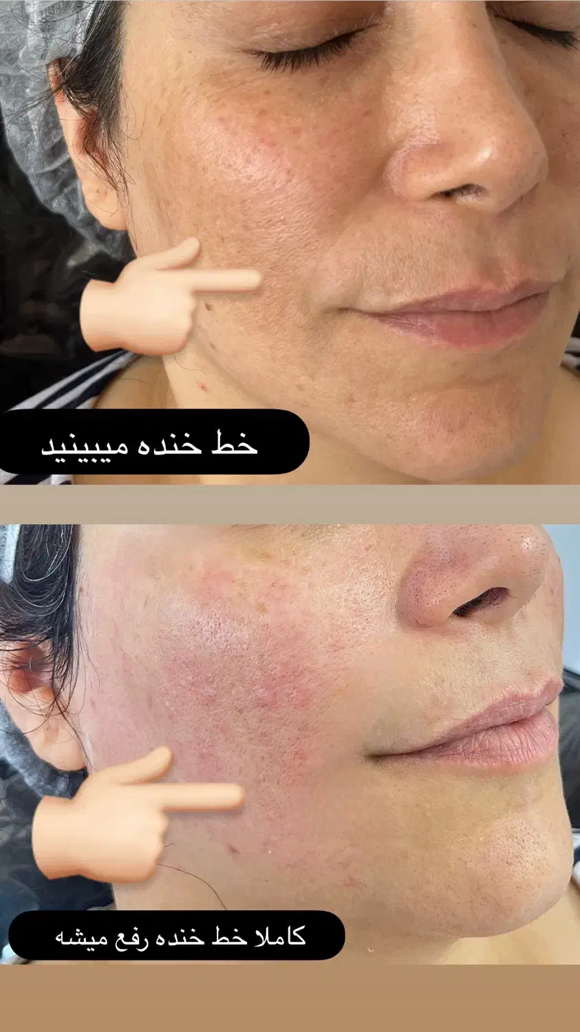 هایفو و جوانسازی صورت باتخفیف باور نکردنی|خدمات آرایشگری و زیبایی|قائمشهر, |دیوار