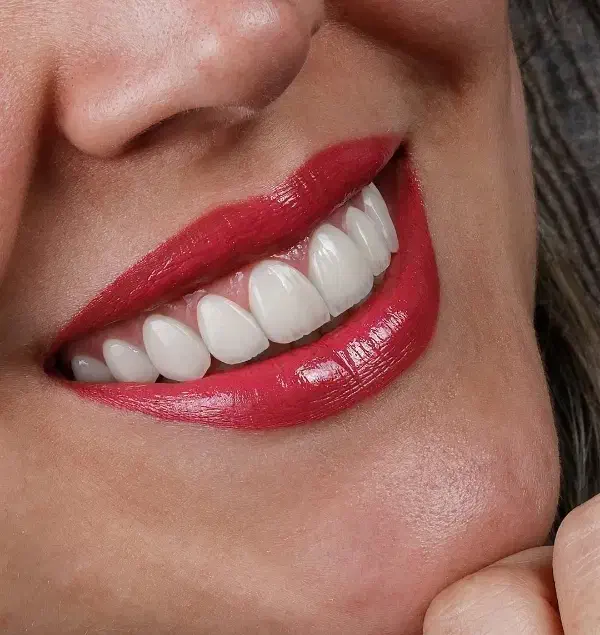 جشنواره کامپوزیت لمینیت روکش عصب ونیر بریدج ترمیم|خدمات آرایشگری و زیبایی|تهران, هفت حوض|دیوار