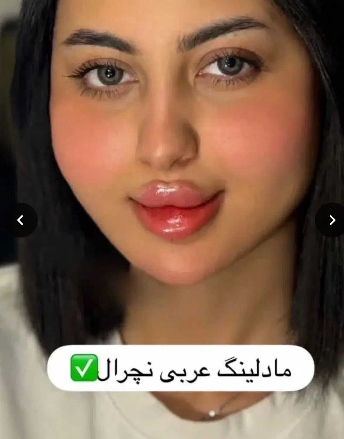 ژل،بوتاکس،فیلربادی باسن بیکینی،پی ارپی زاویه سازی|خدمات زیبایی و سلامت|تبریز, |دیوار