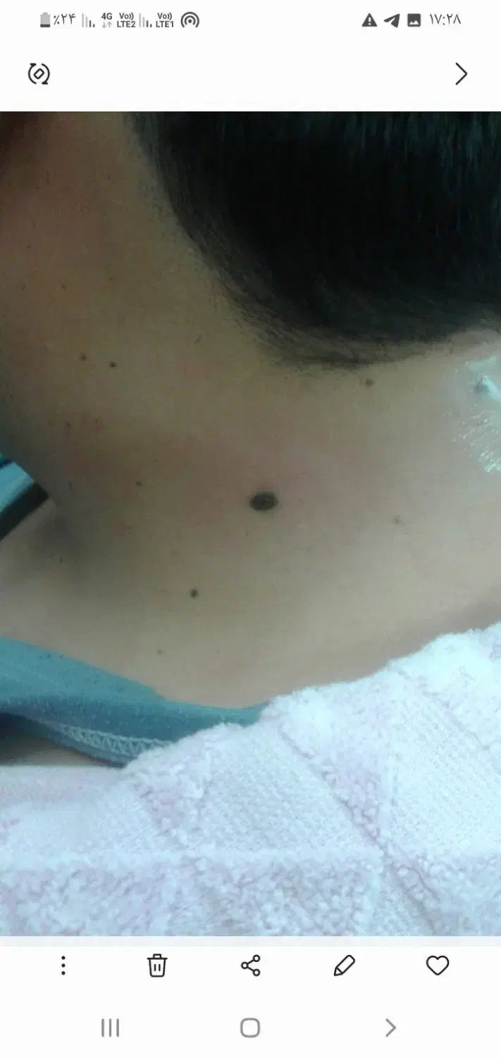 خال برداری|خدمات آرایشگری و زیبایی|ورامین, ورامین|دیوار