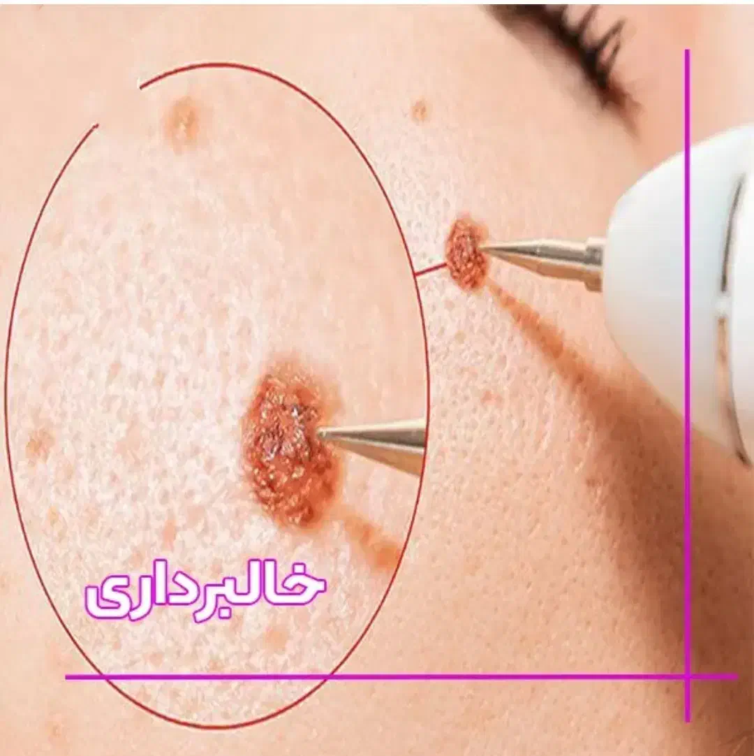 برداشتن خال و زگیل با دستگاه مطمئن و ایمن|خدمات آرایشگری و زیبایی|شهریار, شهرک وائین|دیوار