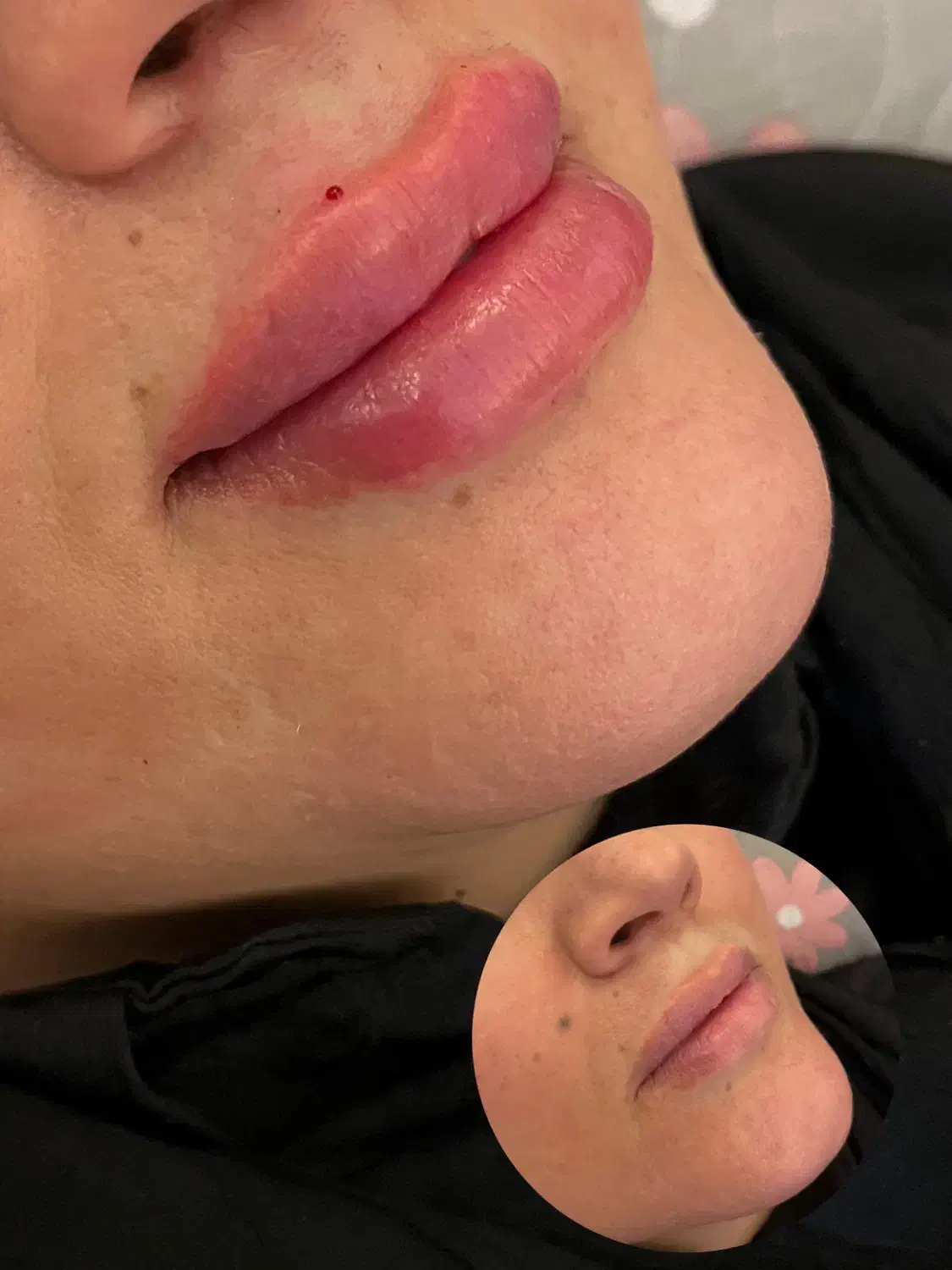 تزریق ژل و بوتاکس فقط۷۵۰|خدمات آرایشگری و زیبایی|هشتگرد, شهرک راه آهن|دیوار