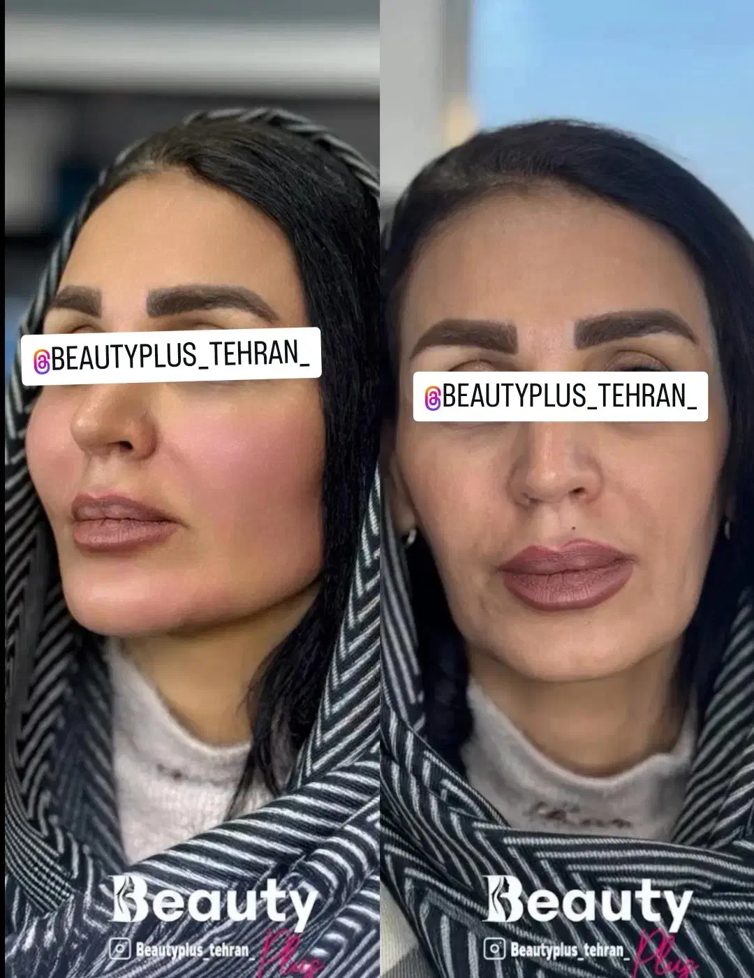 ساکشن غبغب وتزریق چربی بصورت و هرناحیه ازبدن درمطب|خدمات آرایشگری و زیبایی|قم, زنبیل آباد|دیوار