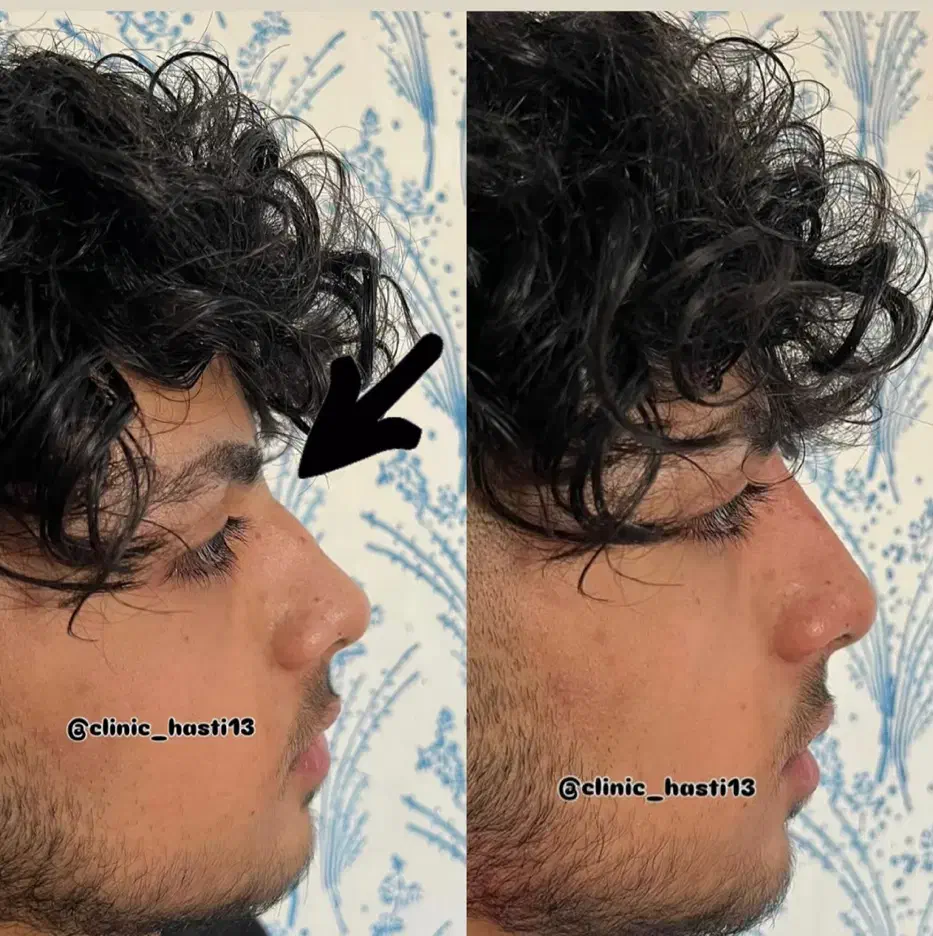 ژل ،بوتاکس، کوچک کردن بینی ،جوانسازی در کیلینیک|خدمات آرایشگری و زیبایی|کرمانشاه, |دیوار