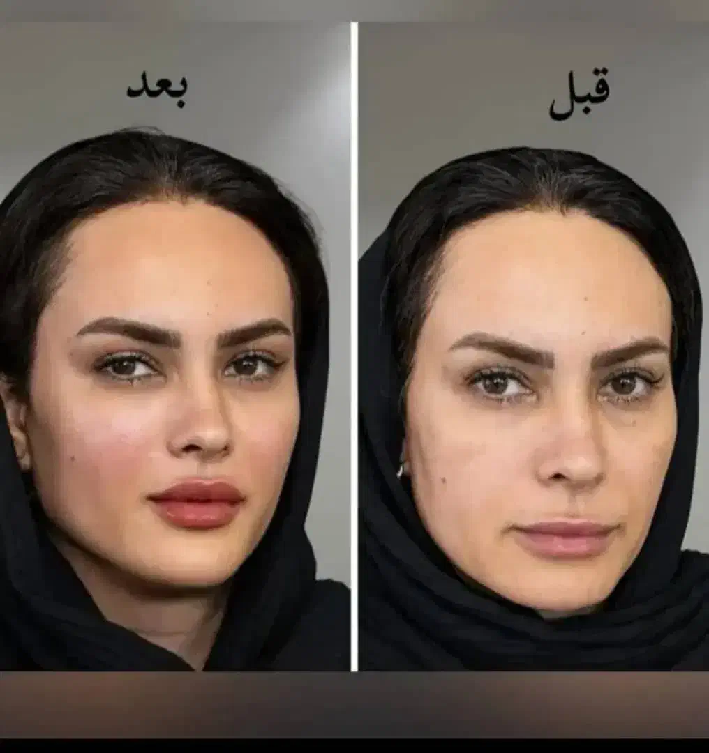 آف ویژه فیلر فول فسی  و مدلینگ صورت فقط ۳۹۰۰|خدمات آرایشگری و زیبایی|کرج, گوهردشت|دیوار
