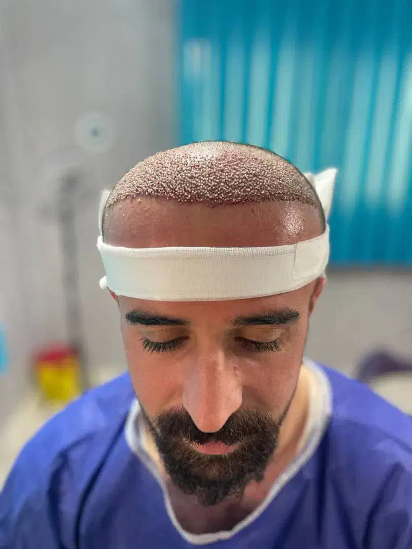 کاشت مو،ابرو،ریش|خدمات آرایشگری و زیبایی|بیرجند, |دیوار