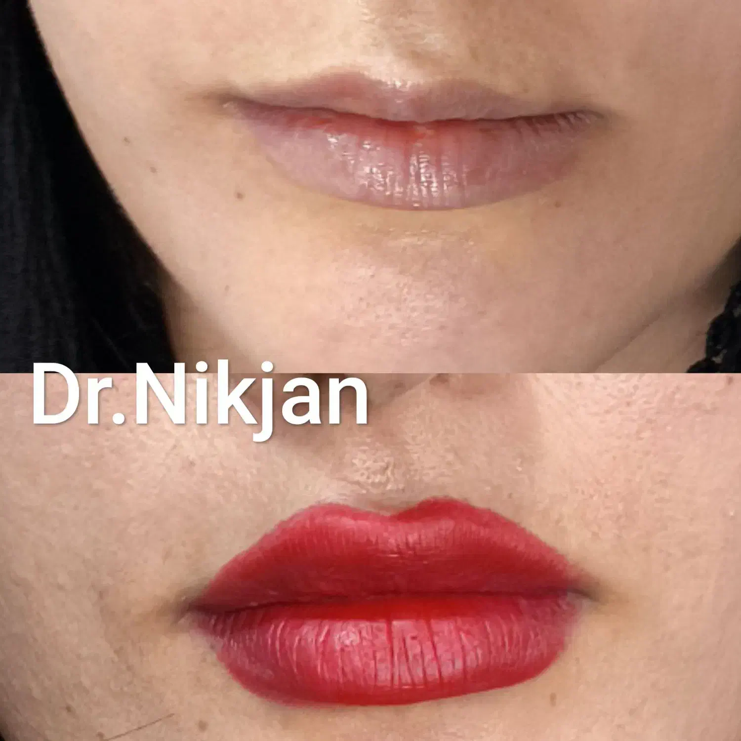 فیلر/بوتاکس/لب روسی/جوانساز/مزوژل مطب دکتر نیک جان|خدمات آرایشگری و زیبایی|رشت, گلسار|دیوار