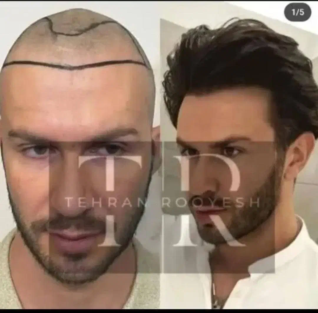 جشنواره کاشت مو یک روزه فول تراکم|خدمات آرایشگری و زیبایی|تهران, دزاشیب|دیوار