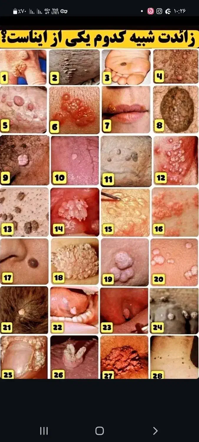 بهبود کامل زگیل و تبخال در بدن|آرایشی، بهداشتی، درمانی|قم, بکایی|دیوار