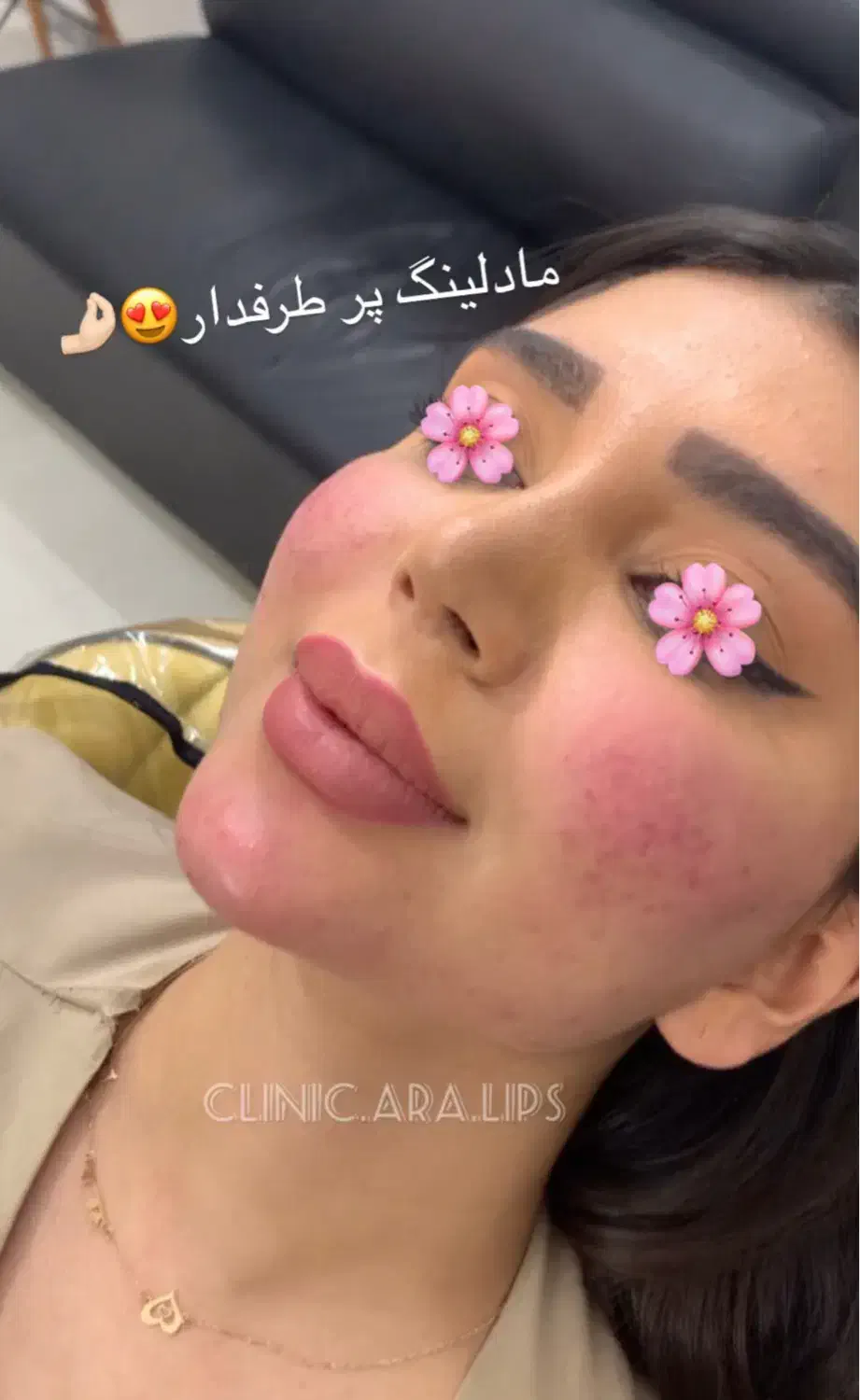 ژل/بوتاکس/مزو ژل/وآموزش|خدمات آرایشگری و زیبایی|خرمشهر, |دیوار