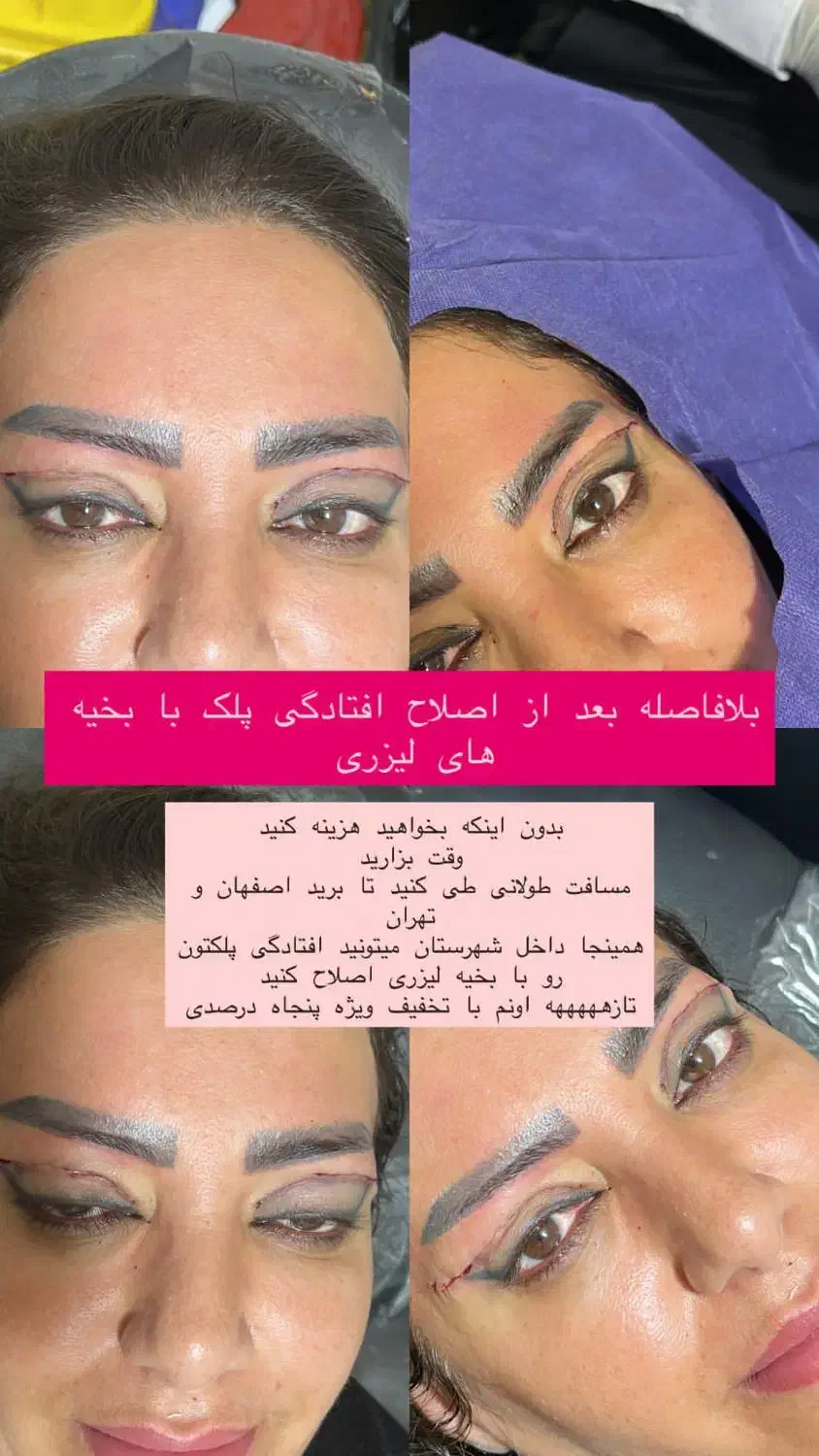 مطب زیبایی لیزر بوتاکس ژل مزو نخ لک جوش|خدمات آرایشگری و زیبایی|لردگان, |دیوار