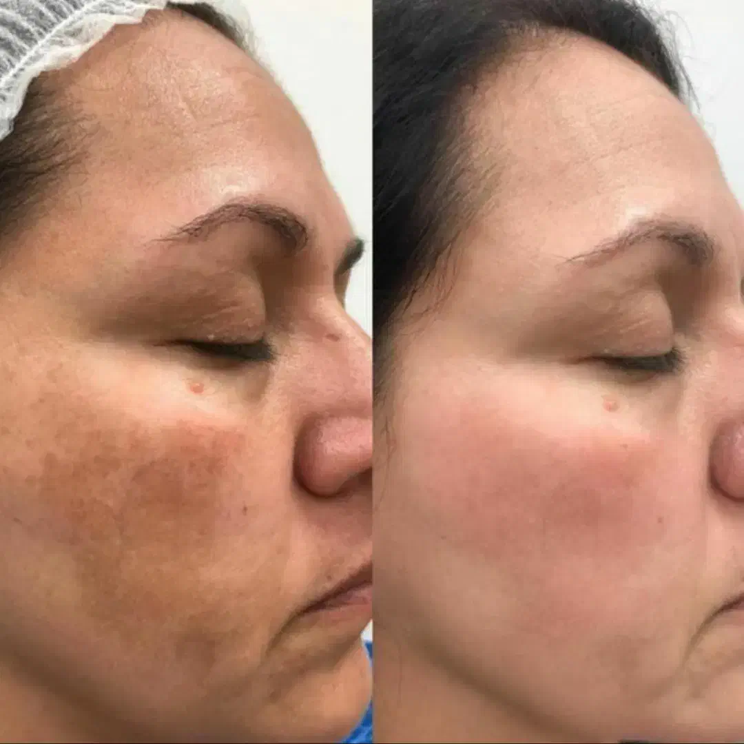 فیشیال و پاکسازی پوست|خدمات آرایشگری و زیبایی|شیراز, قصرالدشت|دیوار