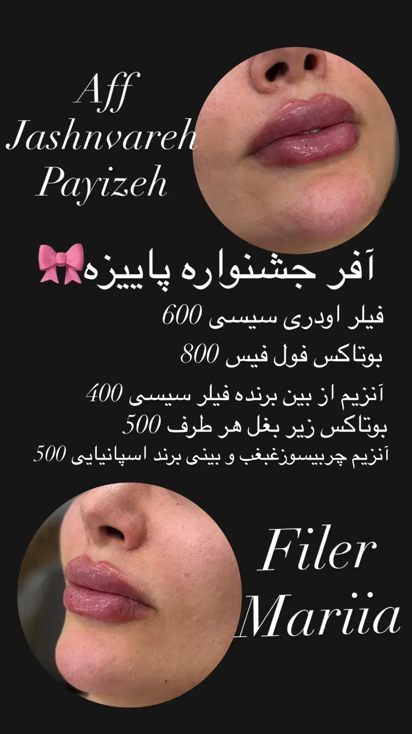 تزریق فیلر صورت مطابق المانهای زیبایی شناسی|خدمات آرایشگری و زیبایی|قرچک, پویینک|دیوار