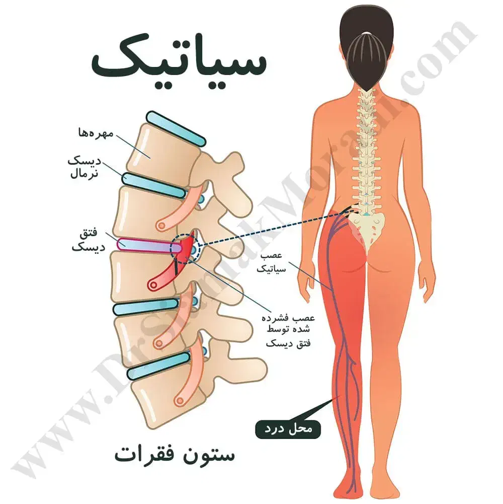 درمان سیاتیک|فعالیت داوطلبانه تحقیقاتی|شیراز, شهرک گلها|دیوار