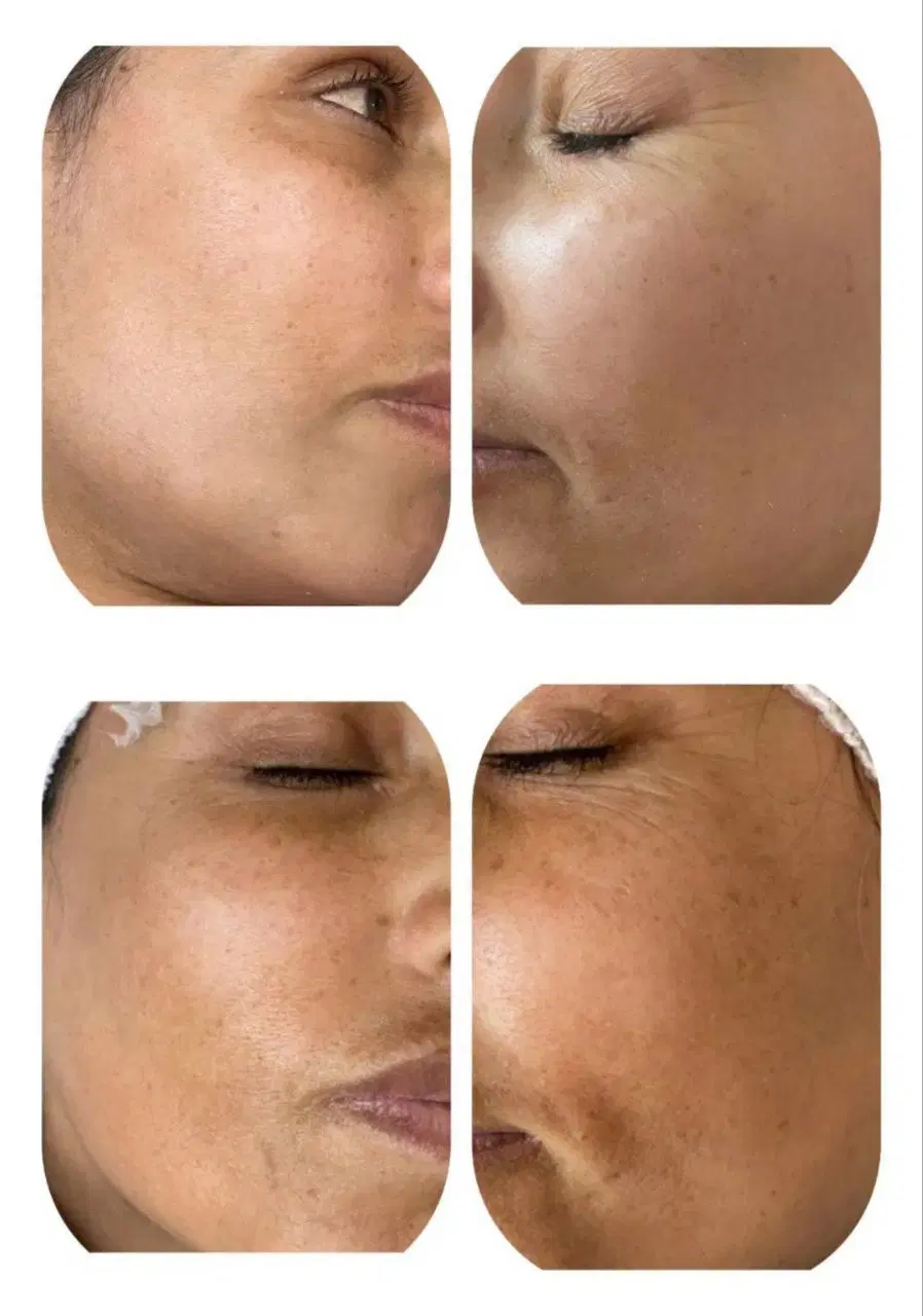 فشیال و پاکسازی پوست و خدمات درمانی جشنواره تخفیف%|خدمات زیبایی و سلامت|مشهد, استاد یوسفی (شهرک غرب)|دیوار