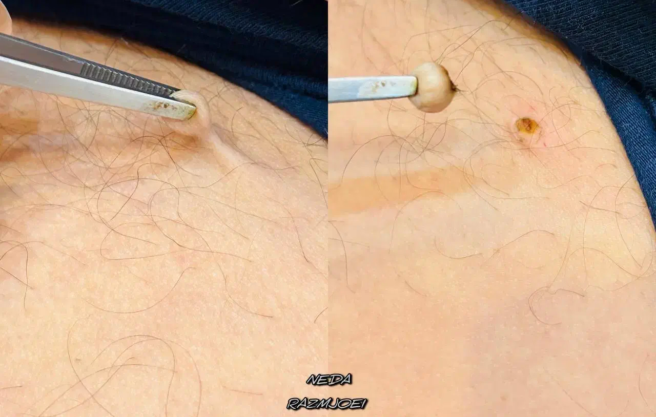 برداشتن انواع خال گوشتی،زگیل،منگوله،کک مک|خدمات آرایشگری و زیبایی|شیراز, شهرک امیر کبیر|دیوار