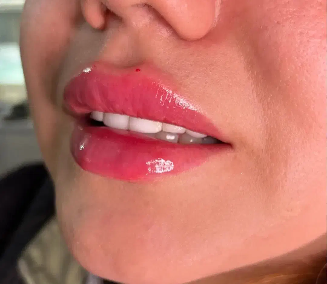 تزریق فیلر و کاشت ناخن|خدمات آرایشگری و زیبایی|خواف, |دیوار