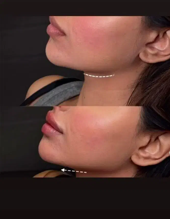 فیلر لب،چونه،گونه،فول فیس،باسن|خدمات آرایشگری و زیبایی|مشهد, سجاد شهر|دیوار