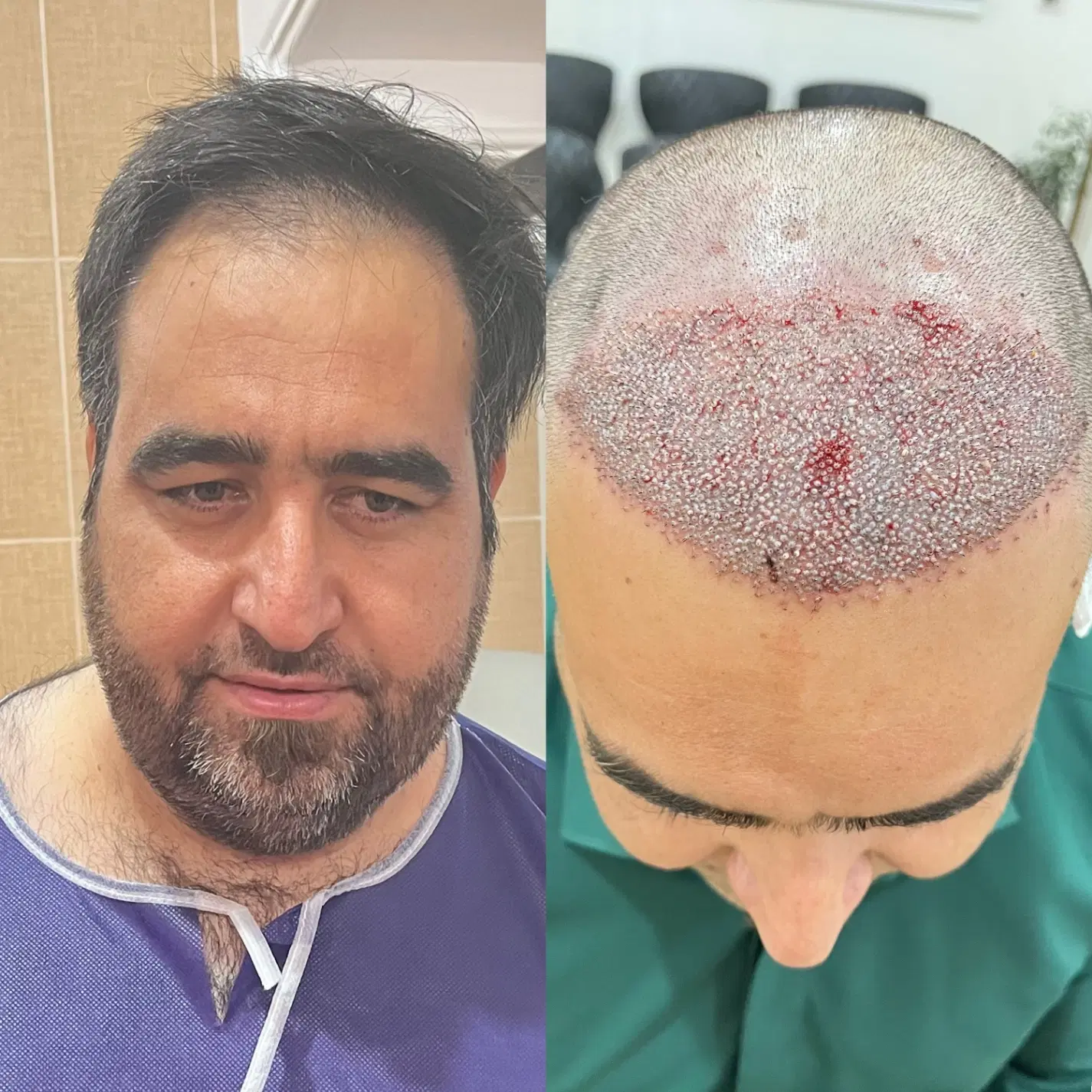 کاشت مو|خدمات آرایشگری و زیبایی|جیرفت, |دیوار