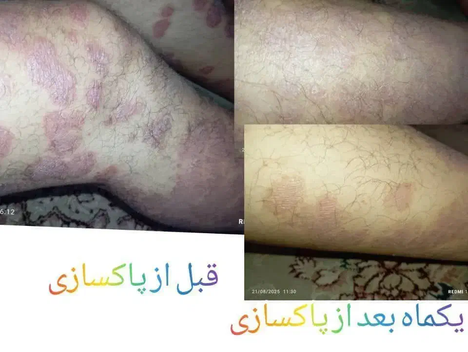 درمان قطعی وبدون بازگشت پوستی|آرایشی، بهداشتی، درمانی|سیرجان, |دیوار