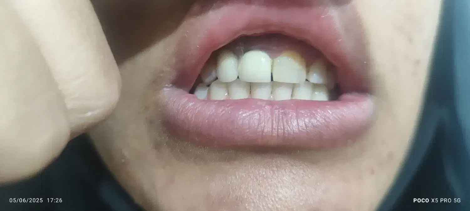 دندان مصنوعی|آرایشی، بهداشتی، درمانی|لردگان, |دیوار