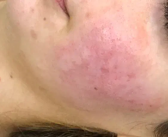 سابسیژن بافت اسکار|خدمات آرایشگری و زیبایی|ایلام, |دیوار