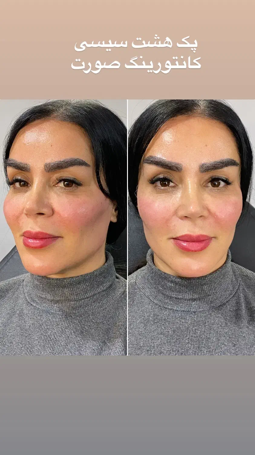 تزریق ژل۶۵۰|خدمات آرایشگری و زیبایی|قزوین, |دیوار