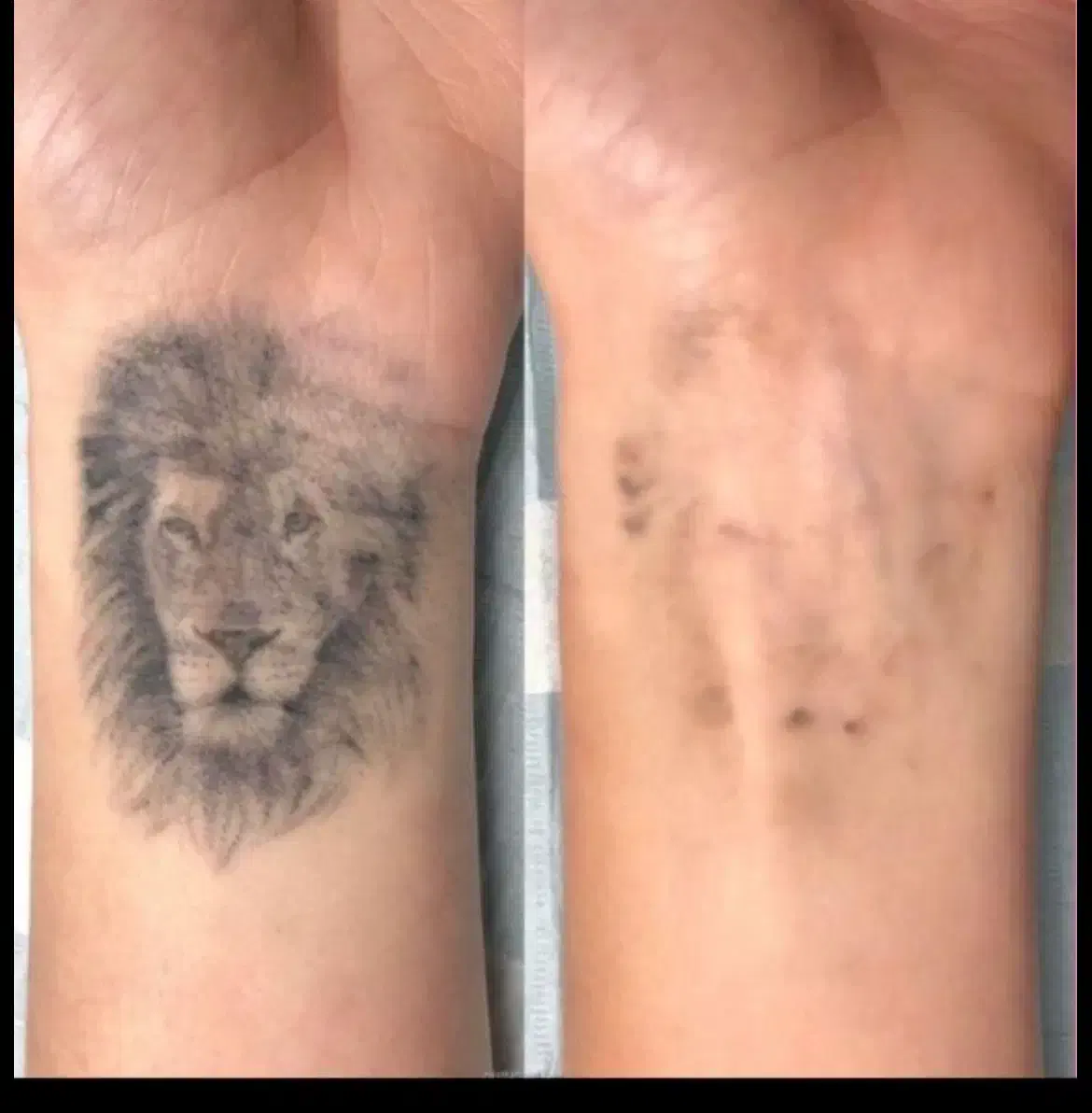 ریموتتو ابرو و بدن با پیشرفته ترین دستگاه تضمینی|خدمات آرایشگری و زیبایی|اهواز, کیانپارس |دیوار