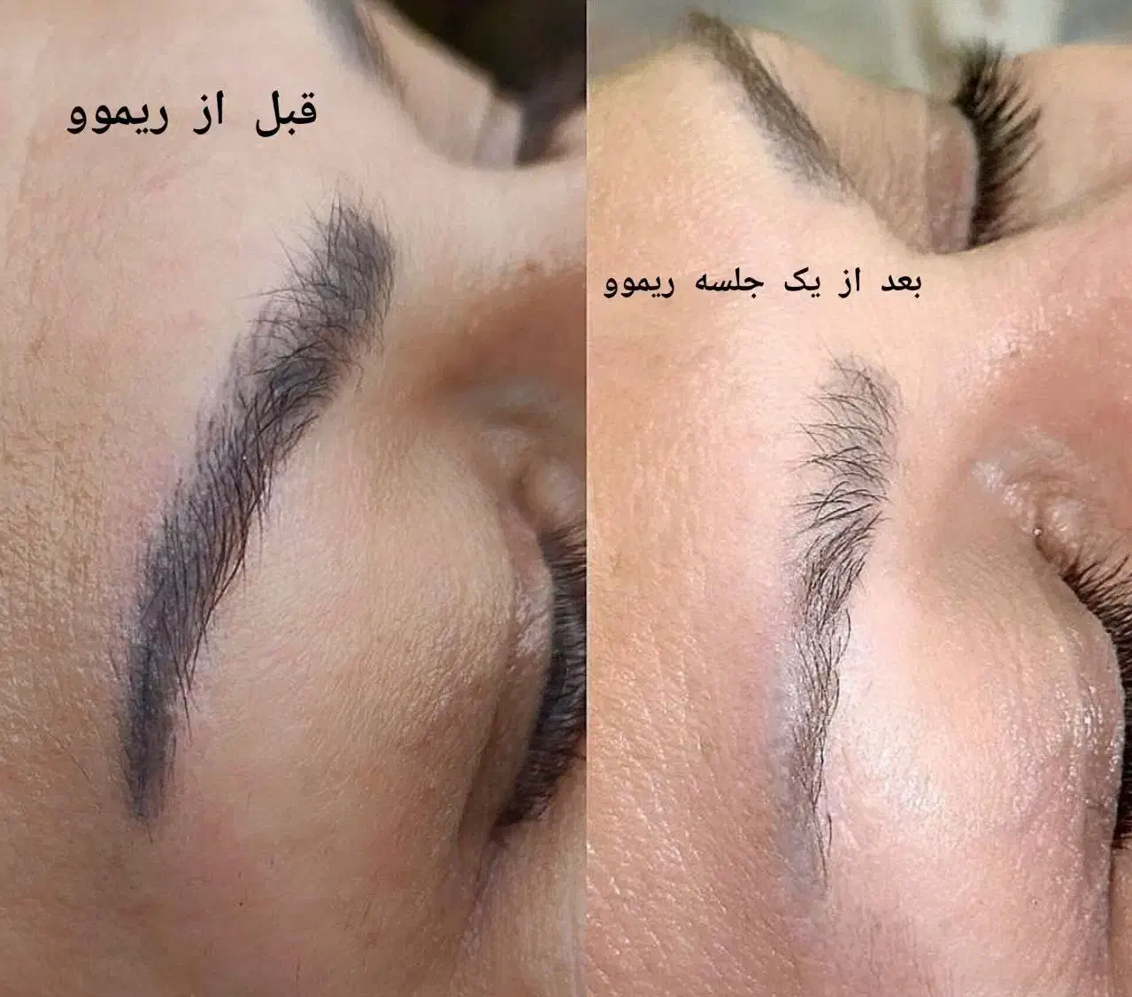 ریموو تتوهای قدیمی تک جلسه ای با آف ویژه|خدمات آرایشگری و زیبایی|شیراز, شهرک ولیعصر|دیوار