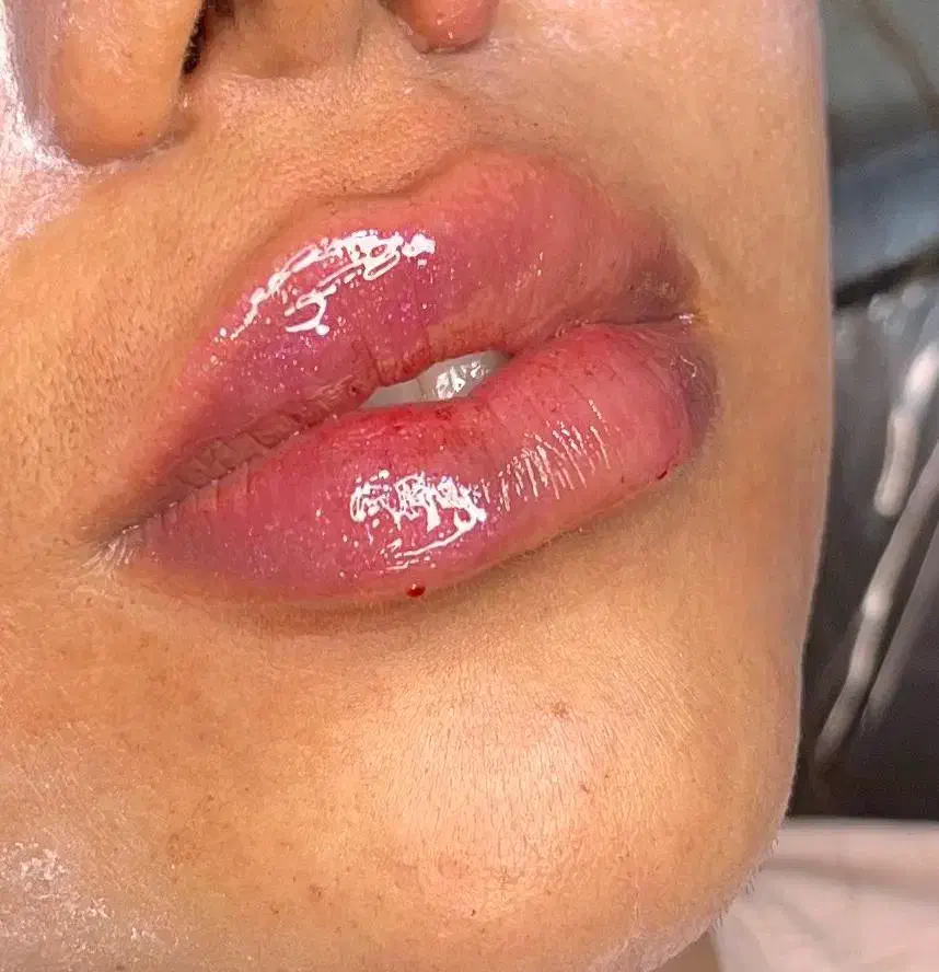 آموزش تخصصی ژل وبوتاکس و مزوتراپی توسط متخصص|خدمات آموزشی|کرج, گلشهر|دیوار