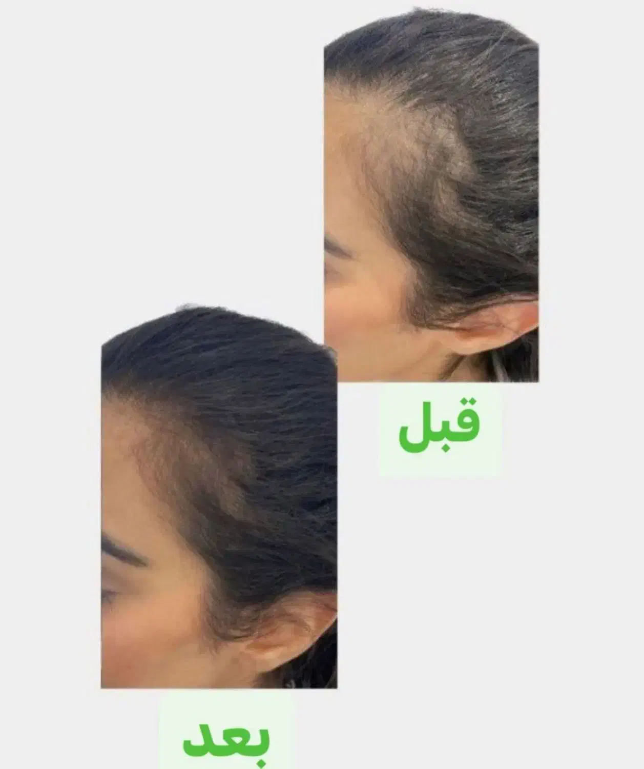 درمان ریزش مو|آرایشی، بهداشتی، درمانی|مشگین شهر, |دیوار