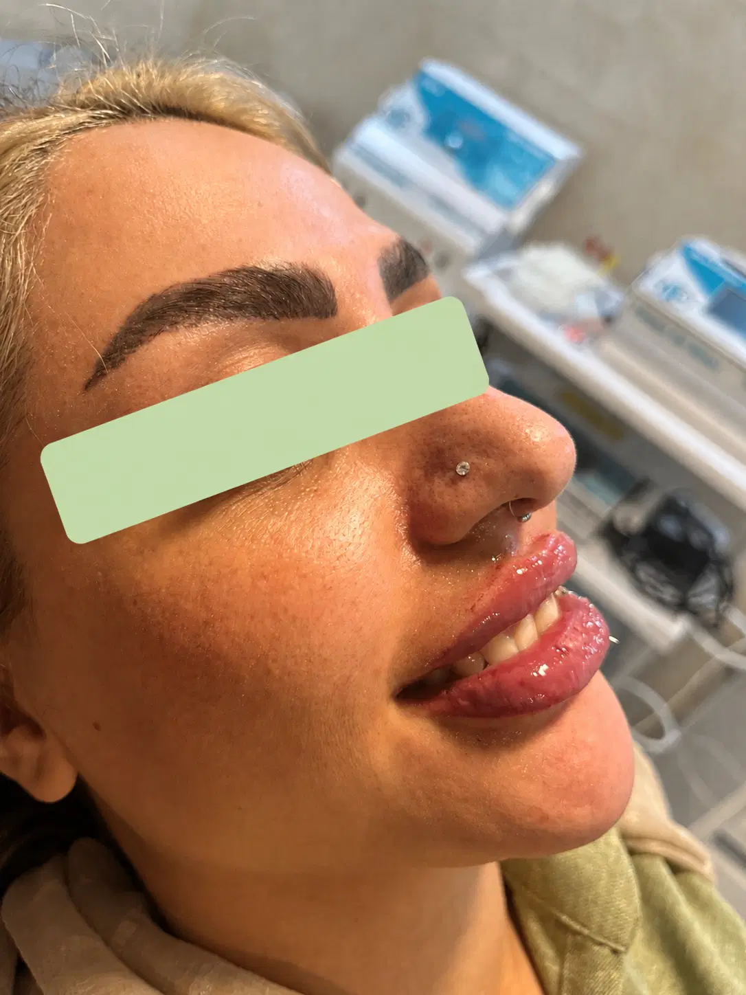 فیلرلب/ژل لب/توسط پزشک/انواع مدل ژل لب|خدمات زیبایی و سلامت|مشهد, عامل|دیوار