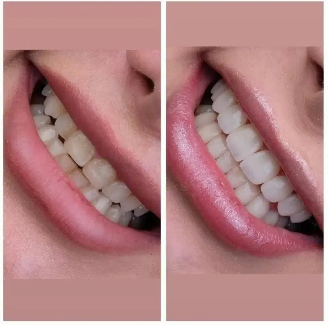 جشنواره کامپوزیت دندان از واحدی 800تومن شروع قیمت|خدمات آرایشگری و زیبایی|صفادشت, |دیوار