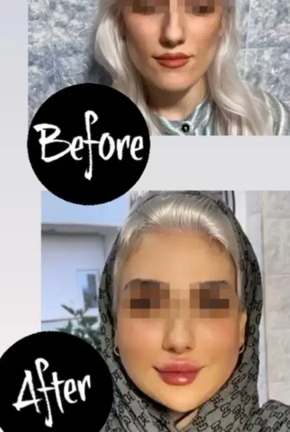 ساکش غبغب تزریق .باسن.شکم|خدمات آرایشگری و زیبایی|کرمانشاه, |دیوار