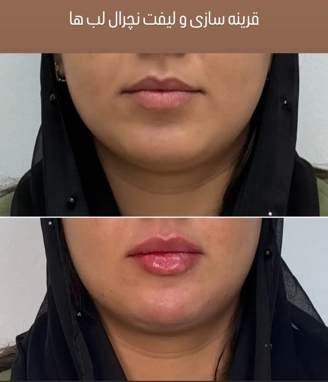 جشنواره ژل لب روسی و بوتاکس|خدمات آرایشگری و زیبایی|فردیس, شهرک ارم|دیوار