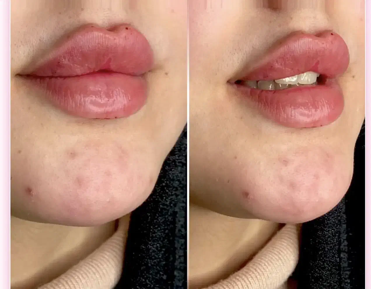 آموزش صفر تا صد زیبایی فیلر و بوتاکس و مزو تراپی|خدمات آرایشگری و زیبایی|اردبیل, |دیوار