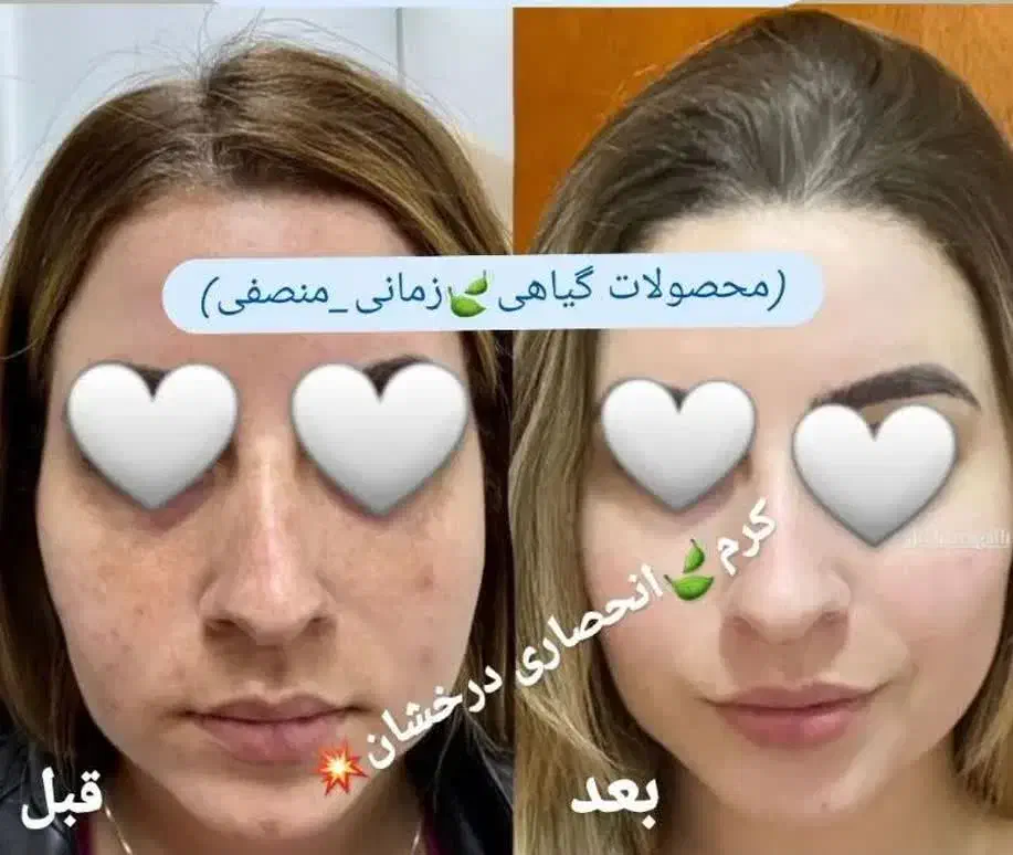 کرم انحصاری درخشان بدون بازگشت|آرایشی، بهداشتی، درمانی|رشت, منظریه|دیوار